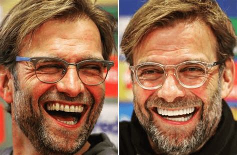 are klopp's teeth fake
